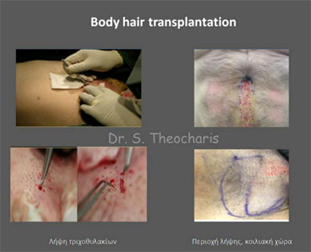 body_transplantation.jpg